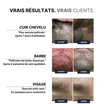 Vos pellicules reviennent ? Plus maintenant.